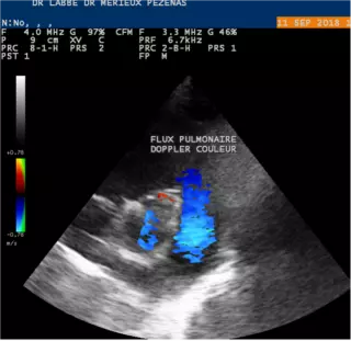 Flux pulmonaire – Doppler couleur