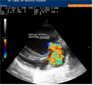 Reflux mitral – Doppler couleur