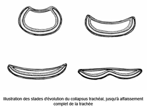 illustration des stades d'évolutions du collapsus trachéal