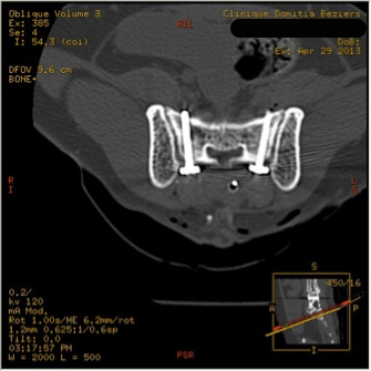 vissage pédiculaire vissage scanner axial