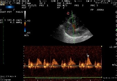 échographie cardiaque