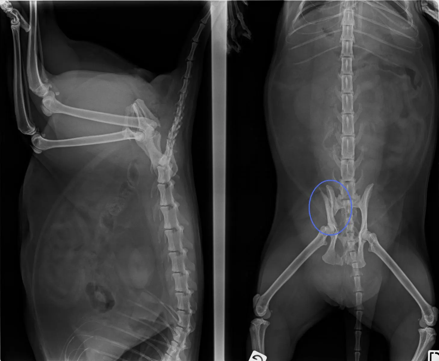 fracture du bassin 1