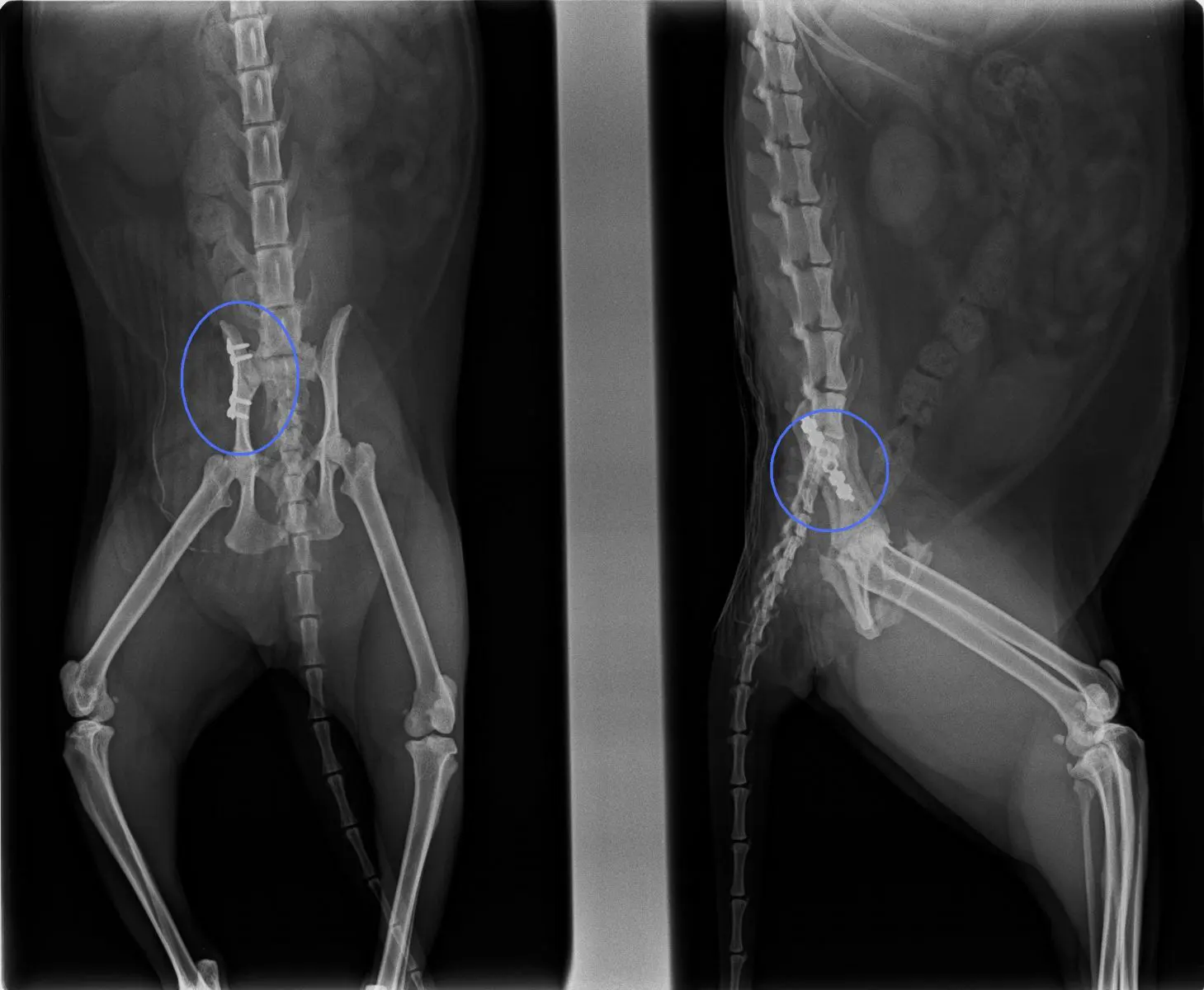 fracture du bassin 2