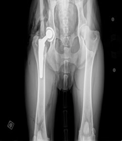 radiographie dysplasie coxo-fémorale post-op